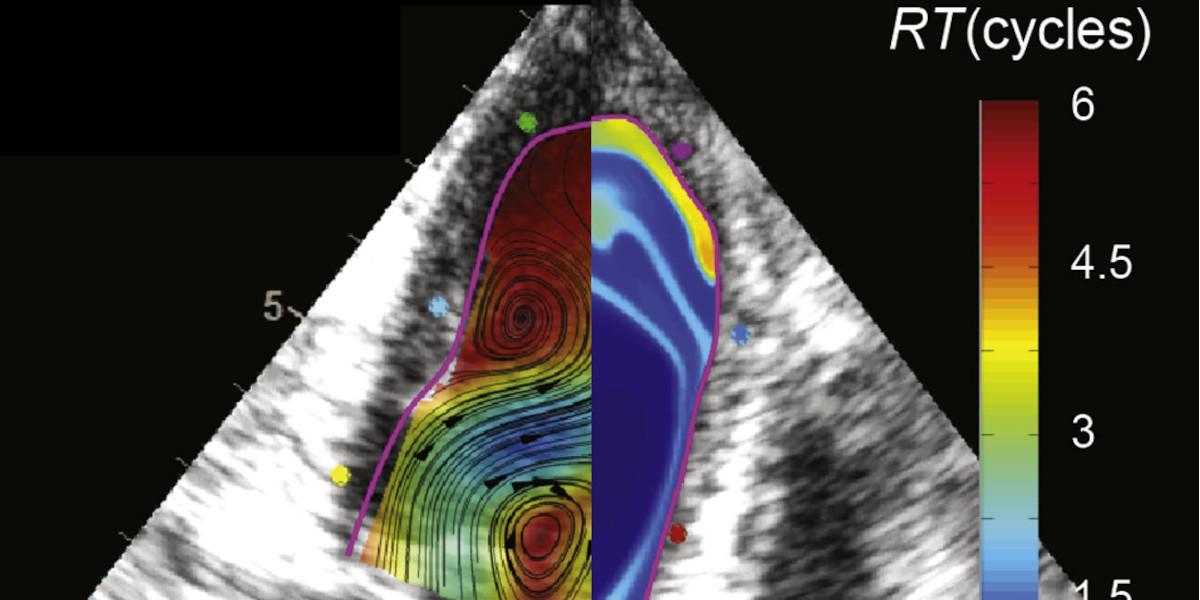 NOTICIA - Seminario sobre índices de estasis ventricular y riesgo cardioembólico