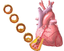 Desarrollo de las placa de ateroma